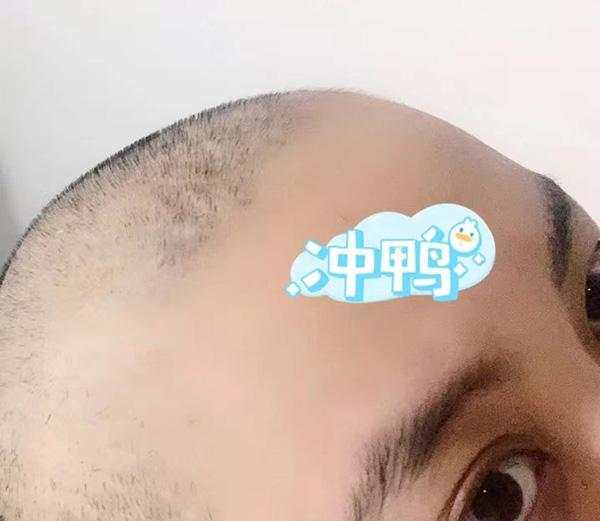 对话|女护士抗疫后患癌:写抗癌日记,教病友化妆调节情绪