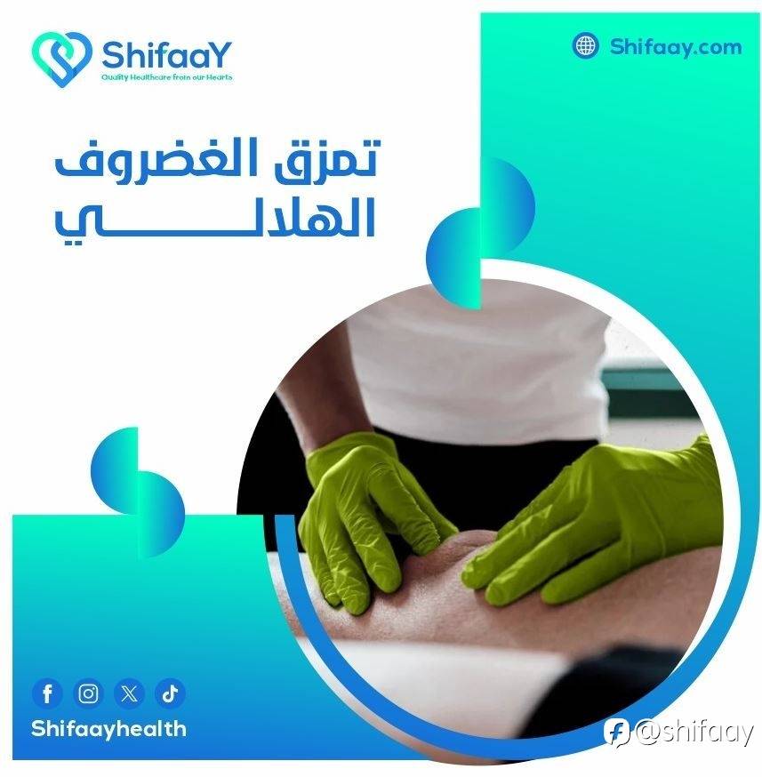 تمزق الغضروف الهلالي