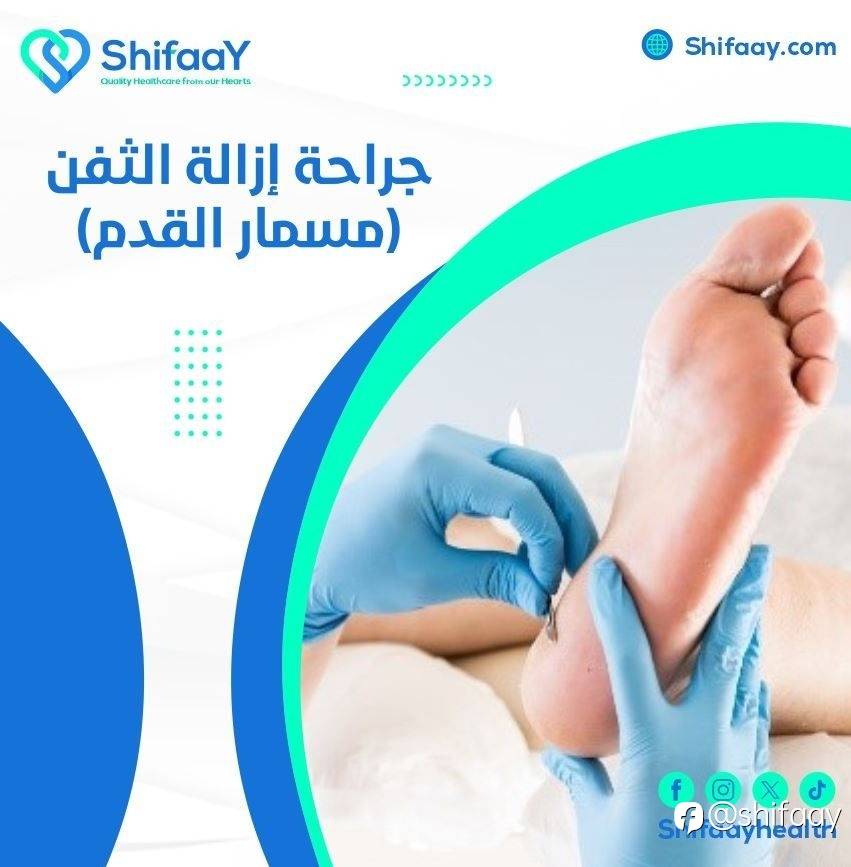 جراحة إزالة الثفن | مسمار القدم
