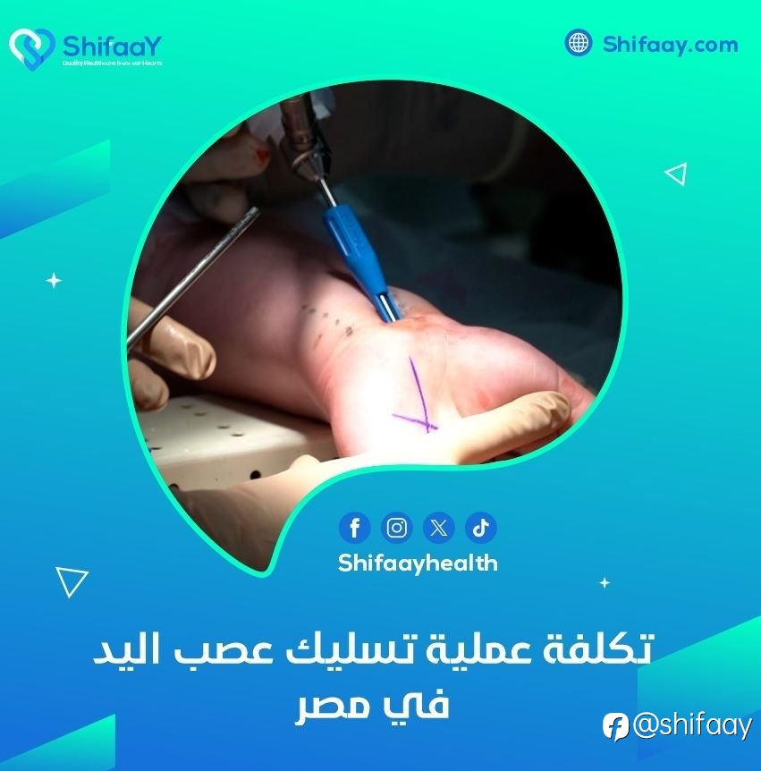 تكلفة عملية تسليك عصب اليد في مصر