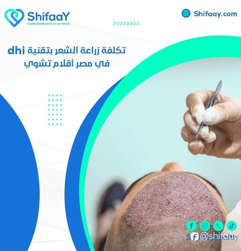 تكلفة زراعة الشعر بتقنية dhi في مصر أقلام تشوي