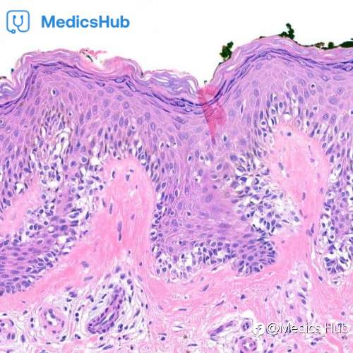 Join the 6th Advanced Online Diagnostic Dermatopathology Course – September 2025